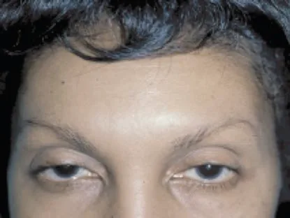 Ptosis palpebral en paciente de 49 años: descenso de 1-2 mm del párpado superior izquierdo aparecido unos 10 días después de un tratamiento con onabotulinumtoxinA. Es la magnitud típica, pequeña en milímetros y evidente en la mirada. Benedetto 2011, figura 3.33.